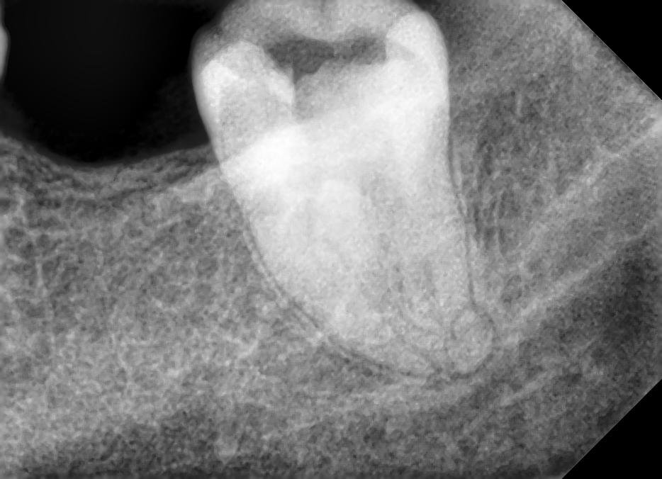 Root Canal