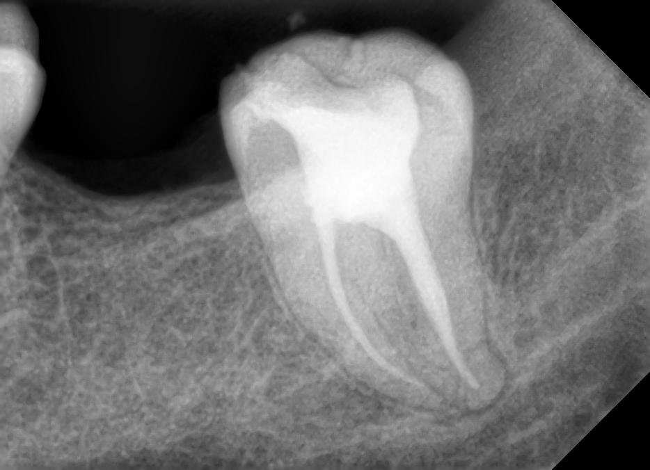 Best Root Canal in Dwarka