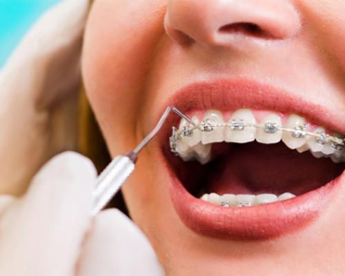 what-is-accelerated-orthodontics-outstanding-ortho-blog